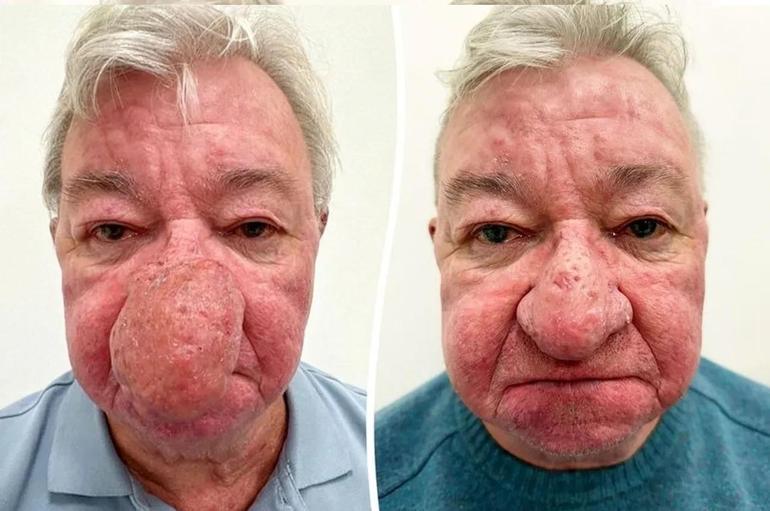 Burnu giderek büyüdü. 68 yaşındaki adam kabus gördü ve 4 saatlik operasyonla adeta yeniden doğdu.