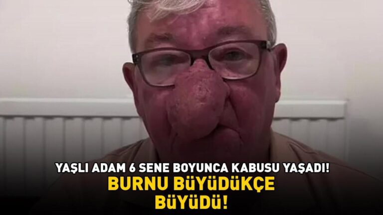 Burnu giderek büyüdü! 68 yaşındaki adam kabusunu yaşadı! 4 saat süren operasyonla adeta yeniden doğdu
